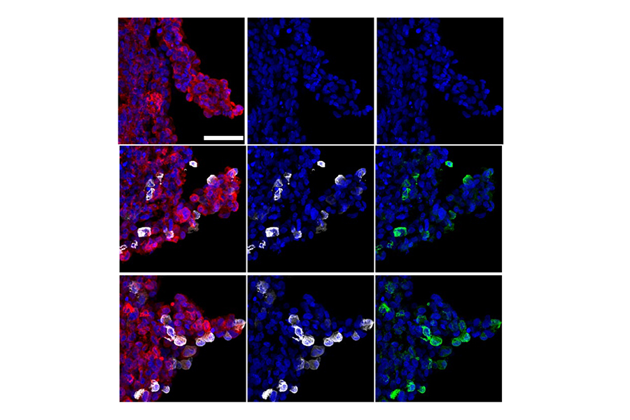 SARS-CoV-2 infects brain cells.