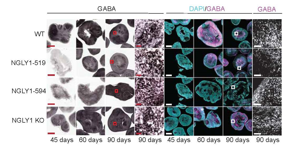 A disease slows the production of a key brain chemical.