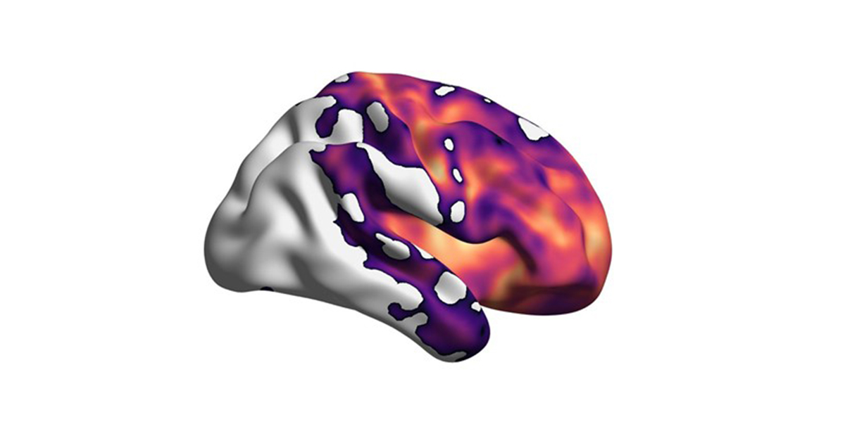 Brain damage represented in neurodegenerative brain disease. 