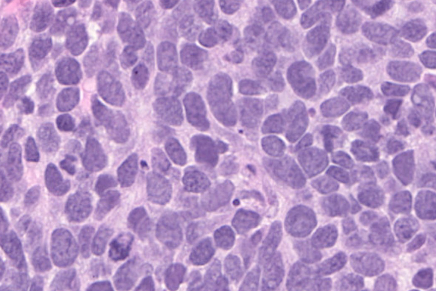 Lung cancer cells