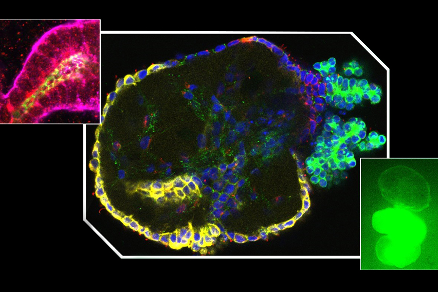 Image shows mini kidney tube structures that have sugar receptors and form outward-facing polycystic kidney disease cysts, which swell by taking in sugar.